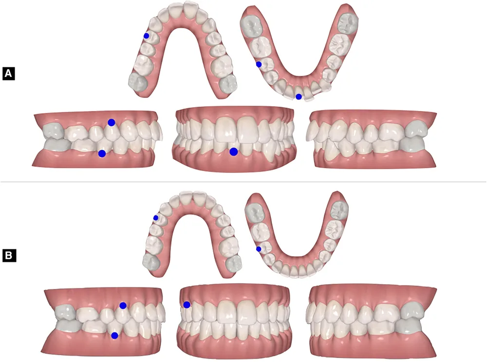 Mô hình răng ba chiều trên phần mềm lập kế hoạch: hàng trên (A) là vị trí răng lúc bắt đầu, hàng dưới (B) là vị trí dự kiến khi kết thúc; một số răng có chấm màu xanh