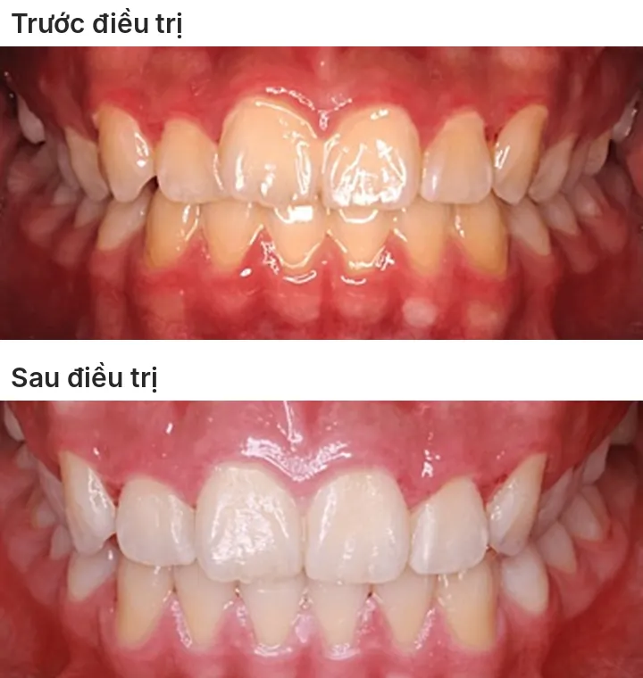 Ảnh trong miệng nhìn chính diện: phía trên là trước điều trị, răng cửa chen chúc và nghiêng ra trước; phía dưới là sau điều trị, các răng được sắp đều