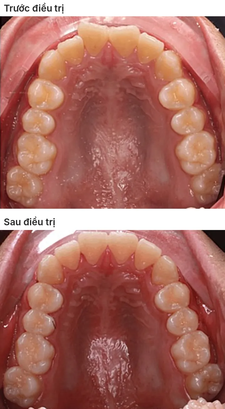 Hàm trên nhìn từ mặt nhai: phía trên là trước điều trị, răng cửa chen chúc; phía dưới là sau điều trị, các răng cửa xếp thành cung đều