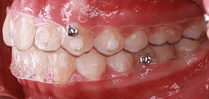 Ảnh trong miệng nhìn bên trái khi đang đeo khay trong suốt; có nút kim loại nhỏ gắn trên răng nanh hàm trên và trên một răng hàm dưới
